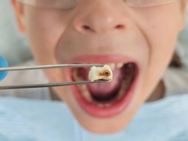 Best Emergency Treatment for Dental Infections or Abscesses in Canton, GA